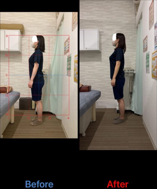 アクル整骨院 | 南町田在住/産後骨盤矯正／37歳女性/第1子出産/産後１か月/施術期間約４か月/ - 063541f3ad302e01158f12f98a4244b7-1062×1280