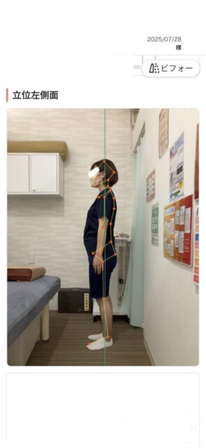 アクル整骨院 | 町田市南町田在住／産後骨盤矯正／産後1か月／第2子出産／33歳女性／施術期間 約3か月／ - 1ce9515de3fec4178f5a30a63413a597-589×1280