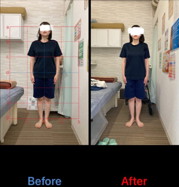 アクル整骨院 | 産後骨盤矯正／38歳女性／第二子出産／産後５か月／施術期間約４か月／町田市小川在住 - 1dc14f7c6d932cfb868590e5ed705f5b-1232×1280