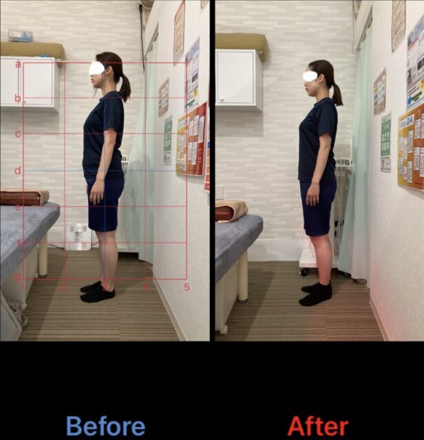 アクル整骨院 | 町田市鶴間在住/産後骨盤矯正／31歳女性／第二子出産／産後1か月／施術期間約４か月／ - 21e5c6ece0668483f22eedf407518a17-1232×1280