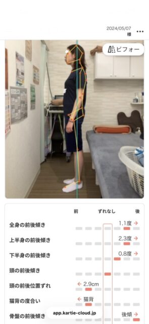 アクル整骨院 | 産後骨盤矯正／町田市金森在住/33歳女性／産後3か月／第1子出産／施術期間 約4か月 - 2f829b9fe890f308d3abda254049ec85-589×1280