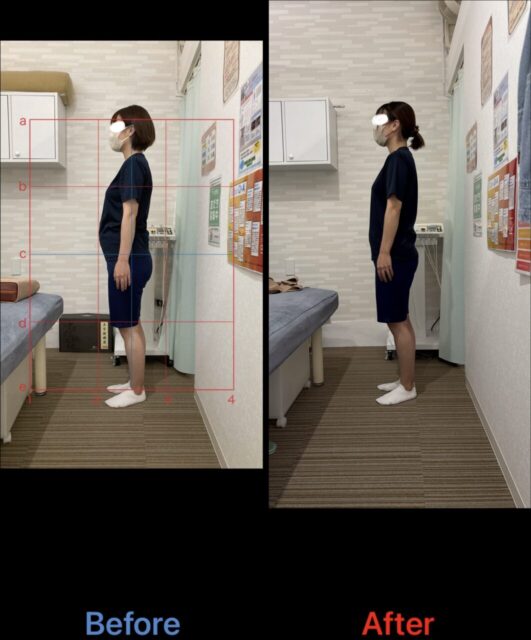 アクル整骨院 | 町田市南町田在住／産後骨盤矯正／産後1か月／第2子出産／33歳女性／施術期間 約3か月／ - 3dd1b9ba8684aa3ba21f40c3153979ea-1-1062×1280