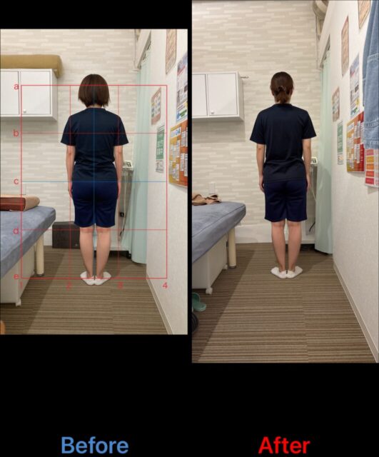 アクル整骨院 | 町田市南町田在住／産後骨盤矯正／産後1か月／第2子出産／33歳女性／施術期間 約3か月／ - 3f10ea0c99079433e2fe489a11e51fac-1062×1280