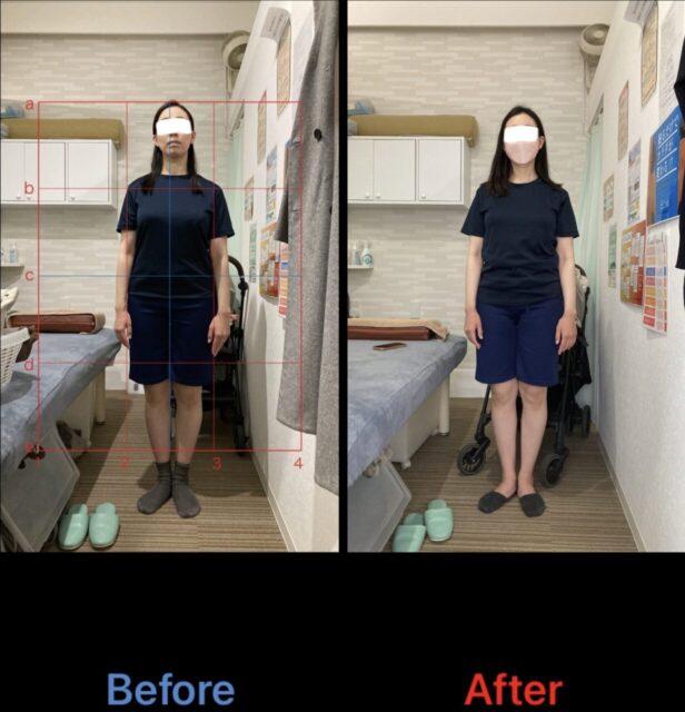 アクル整骨院 | 南町田在住/産後骨盤矯正／31歳女性／産後4か月／第一子出産／施術期間約4か月／ - 571c12793452c9375947b61eba0aa152-1232×1280