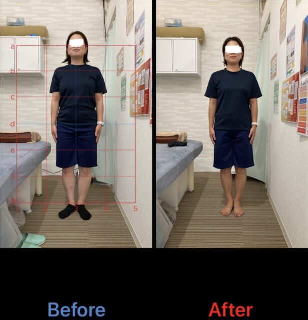 アクル整骨院 | 南町田在住/産後骨盤矯正／36歳女性／産後9か月／第二子出産／施術期間 約４か月／ - 71b3c7b19dbf4fddae38a32387c83cba-1232×1280