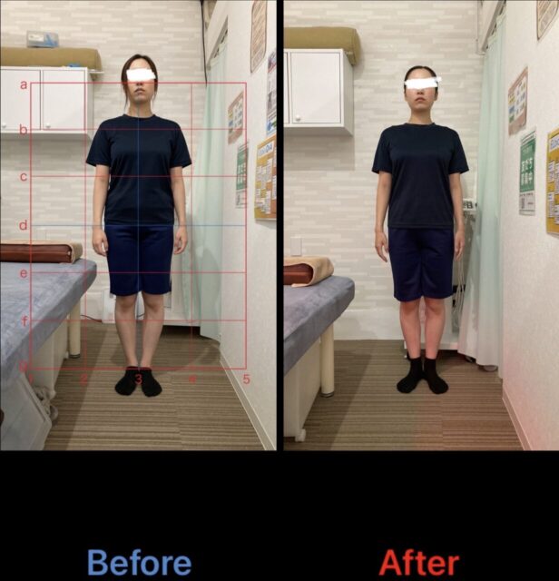 アクル整骨院 | 町田市鶴間在住/産後骨盤矯正／31歳女性／第二子出産／産後1か月／施術期間約４か月／ - 74b8f01c52831fedc44782c72674c120-1232×1280