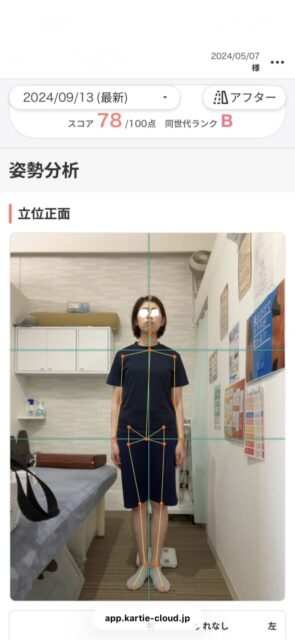 アクル整骨院 | 産後骨盤矯正／町田市金森在住/33歳女性／産後3か月／第1子出産／施術期間 約4か月 - 962ba014636883090ed1e2355f44b226-589×1280