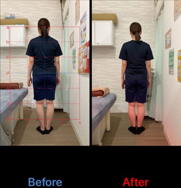 アクル整骨院 | 町田市鶴間在住/産後骨盤矯正／31歳女性／第二子出産／産後1か月／施術期間約４か月／ - a87005bb0634728b62f5edaad80272ba-1232×1280