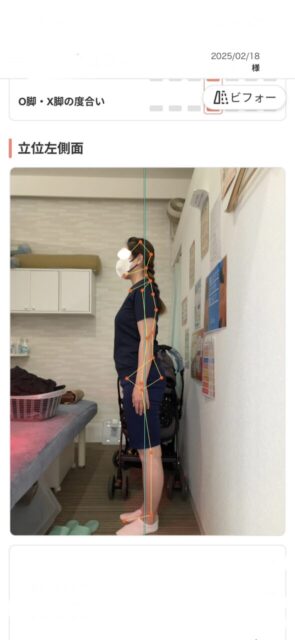 アクル整骨院 | 産後骨盤矯正／42歳女性／産後10か月／第3子出産／施術期間 約4か月／町田市小川在住 - b500500865ee462ceb40bdd2914a228d-589×1280