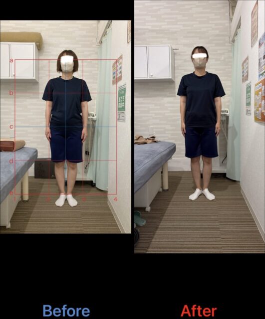 アクル整骨院 | 町田市南町田在住／産後骨盤矯正／産後1か月／第2子出産／33歳女性／施術期間 約3か月／ - e29e8d5f105be448e2d9b352878f14fa-1062×1280