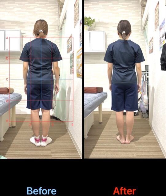 アクル整骨院 | 産後2か月／産後骨盤矯正／町田市金森在住/32歳女性／第1子出産／施術期間 約3か月 - 7fd00adae69116fd1e5509d7da327691-1297×1536