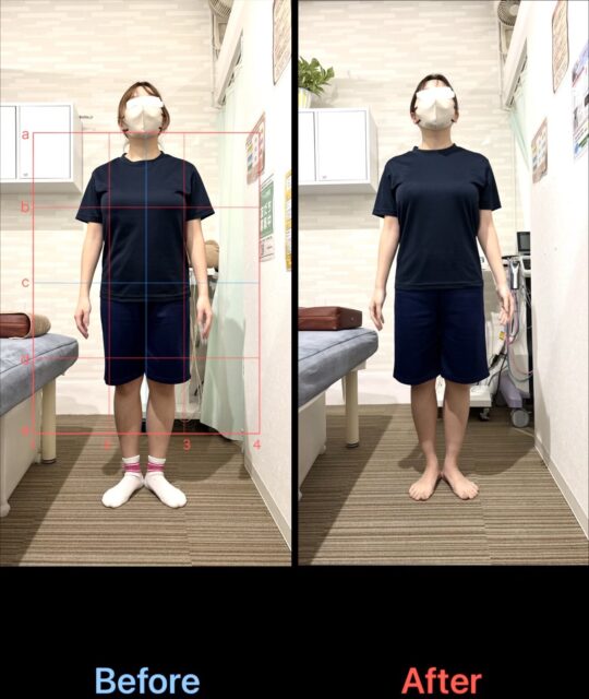 アクル整骨院 | 産後2か月／産後骨盤矯正／町田市金森在住/32歳女性／第1子出産／施術期間 約3か月 - 954ff1954475dd58e4685efd368c081f-1297×1536