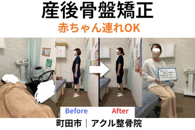 アクル整骨院 | 南町田・成瀬の産後骨盤矯正で　産後半年～１年後以降でも遅くない？産後骨盤矯正でできること　2026.3.10(火) - machida-sango-kotsuban-kyosei-akuru-seikotsuin.jpg